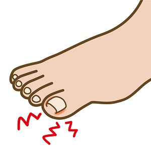 足の巻き爪